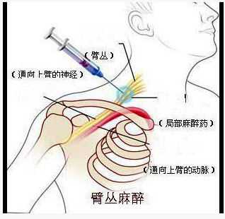 如图示,下列哪种神经可以被锁骨上入路阻滞而不能被腋入路阻滞()