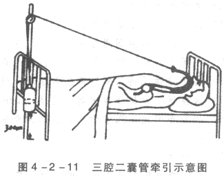 三腔二囊管止血法图片