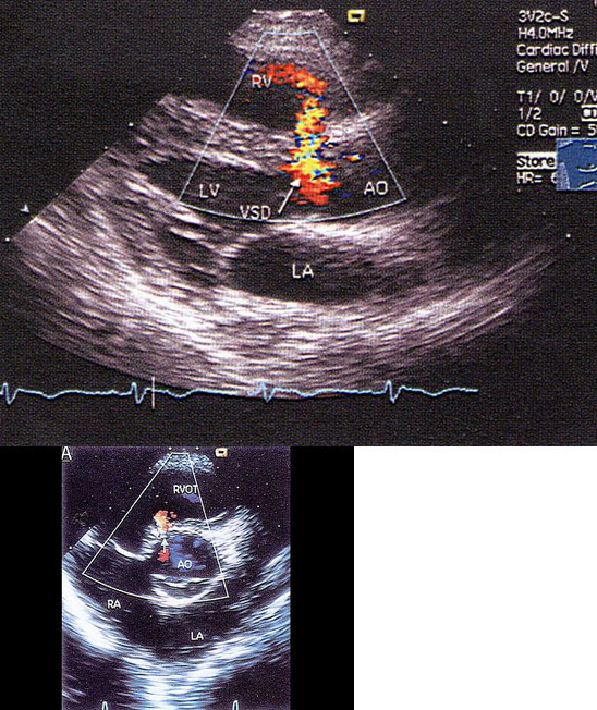 室间隔缺损,以上室间隔缺损属于哪型()